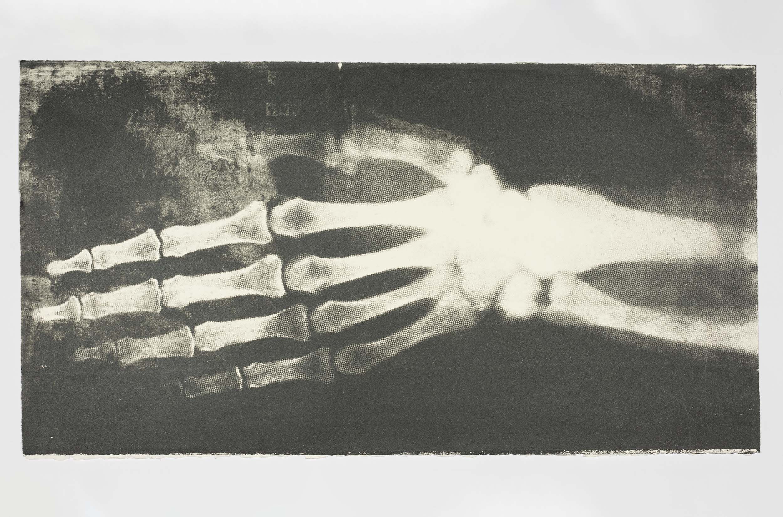 An artwork depicting an x-ray of a person's hand, wrist, and arm bones.